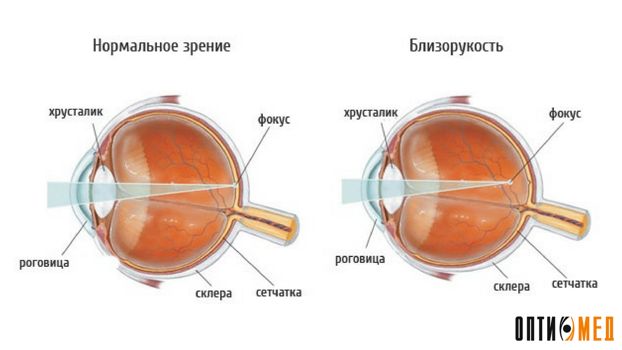 Зрение 1 диоптрия. Миопия (близорукость) гиперметропия (дальнозоркость) астигматизм. Строение глаза дальнозоркость. Строение глаза астигматизм. Близорукость хрусталик.